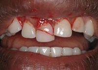 Cracked Bloody Teeth