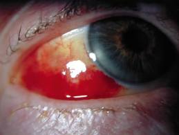 Bloody Eye